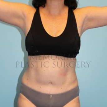 A front view after photo of patient 192 that underwent Abdominoplasty Tummy Tuck procedures at Memorial Plastic Surgery