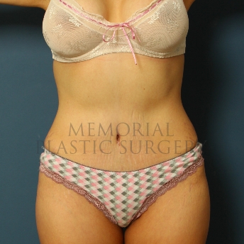 A front view after photo of patient 218 that underwent Abdominoplasty Tummy Tuck procedures at Memorial Plastic Surgery