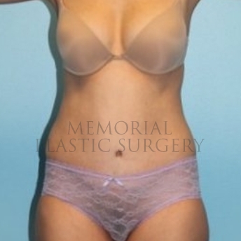 A front view after photo of patient 196 that underwent Abdominoplasty Tummy Tuck procedures at Memorial Plastic Surgery