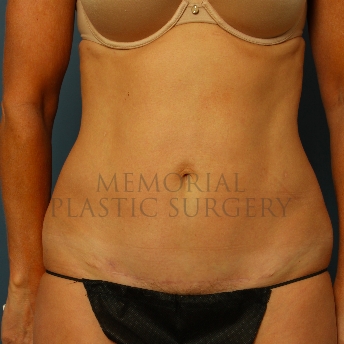 A front view after photo of patient 225 that underwent Abdominoplasty Tummy Tuck procedures at Memorial Plastic Surgery