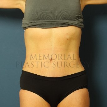 A front view after photo of patient 229 that underwent Abdominoplasty Tummy Tuck procedures at Memorial Plastic Surgery