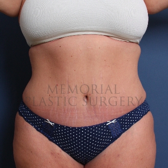 A front view after photo of patient 227 that underwent Abdominoplasty Tummy Tuck procedures at Memorial Plastic Surgery