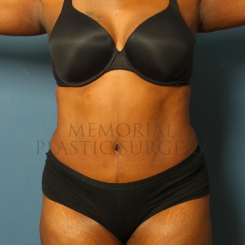 A front view after photo of patient 226 that underwent Abdominoplasty Tummy Tuck procedures at Memorial Plastic Surgery