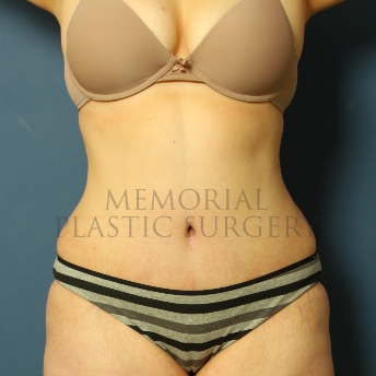 A front view after photo of patient 220 that underwent Abdominoplasty Tummy Tuck procedures at Memorial Plastic Surgery
