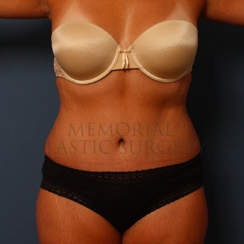 A front view after photo of patient 221 that underwent Abdominoplasty Tummy Tuck procedures at Memorial Plastic Surgery