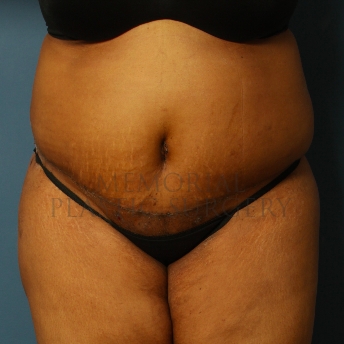 A front view after photo of patient 228 that underwent Abdominoplasty Tummy Tuck procedures at Memorial Plastic Surgery
