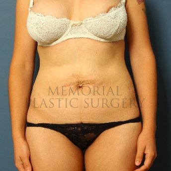 A front view before photo of patient 218 that underwent Abdominoplasty Tummy Tuck procedures at Memorial Plastic Surgery