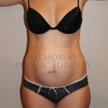 A front view before photo of patient 196 that underwent Abdominoplasty Tummy Tuck procedures at Memorial Plastic Surgery
