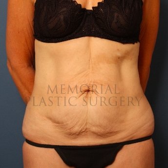 A front view before photo of patient 229 that underwent Abdominoplasty Tummy Tuck procedures at Memorial Plastic Surgery