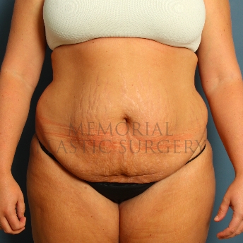 A front view before photo of patient 227 that underwent Abdominoplasty Tummy Tuck procedures at Memorial Plastic Surgery