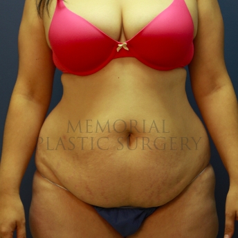 A front view before photo of patient 220 that underwent Abdominoplasty Tummy Tuck procedures at Memorial Plastic Surgery