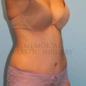 A oblique view after photo of patient 196 that underwent Abdominoplasty Tummy Tuck procedures at Memorial Plastic Surgery