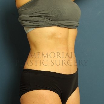 A oblique view after photo of patient 229 that underwent Abdominoplasty Tummy Tuck procedures at Memorial Plastic Surgery