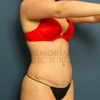 A oblique view after photo of patient 224 that underwent Abdominoplasty Tummy Tuck procedures at Memorial Plastic Surgery