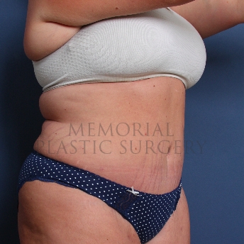 A oblique view after photo of patient 227 that underwent Abdominoplasty Tummy Tuck procedures at Memorial Plastic Surgery