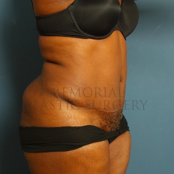 A oblique view after photo of patient 226 that underwent Abdominoplasty Tummy Tuck procedures at Memorial Plastic Surgery