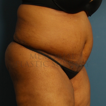 A oblique view after photo of patient 228 that underwent Abdominoplasty Tummy Tuck procedures at Memorial Plastic Surgery
