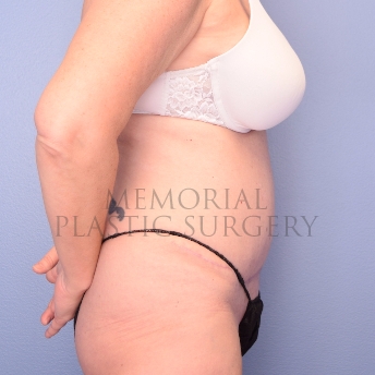 A oblique view after photo of patient 1253 that underwent Abdominoplasty Tummy Tuck procedures at Memorial Plastic Surgery