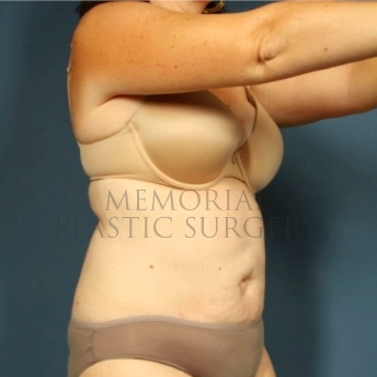 A oblique view before photo of patient 192 that underwent Abdominoplasty Tummy Tuck procedures at Memorial Plastic Surgery
