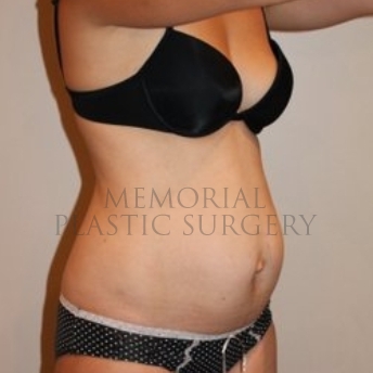 A oblique view before photo of patient 196 that underwent Abdominoplasty Tummy Tuck procedures at Memorial Plastic Surgery