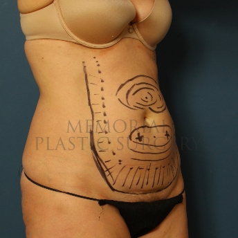 A oblique view before photo of patient 225 that underwent Abdominoplasty Tummy Tuck procedures at Memorial Plastic Surgery