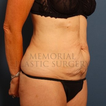 A oblique view before photo of patient 229 that underwent Abdominoplasty Tummy Tuck procedures at Memorial Plastic Surgery