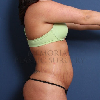 A oblique view before photo of patient 224 that underwent Abdominoplasty Tummy Tuck procedures at Memorial Plastic Surgery