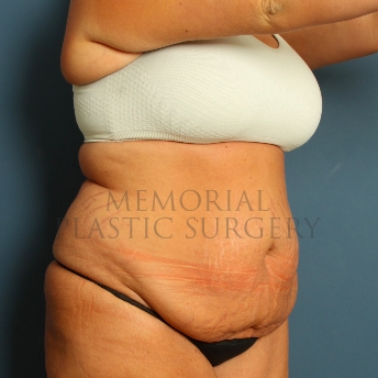A oblique view before photo of patient 227 that underwent Abdominoplasty Tummy Tuck procedures at Memorial Plastic Surgery