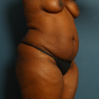 A oblique view before photo of patient 226 that underwent Abdominoplasty Tummy Tuck procedures at Memorial Plastic Surgery