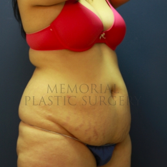 A oblique view before photo of patient 220 that underwent Abdominoplasty Tummy Tuck procedures at Memorial Plastic Surgery