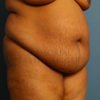 A oblique view before photo of patient 228 that underwent Abdominoplasty Tummy Tuck procedures at Memorial Plastic Surgery