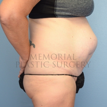 A oblique view before photo of patient 1253 that underwent Abdominoplasty Tummy Tuck procedures at Memorial Plastic Surgery