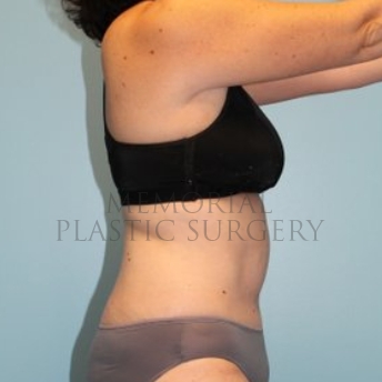 A side view after photo of patient 192 that underwent Abdominoplasty Tummy Tuck procedures at Memorial Plastic Surgery