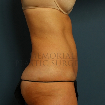 A side view after photo of patient 225 that underwent Abdominoplasty Tummy Tuck procedures at Memorial Plastic Surgery