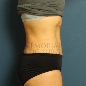 A side view after photo of patient 229 that underwent Abdominoplasty Tummy Tuck procedures at Memorial Plastic Surgery
