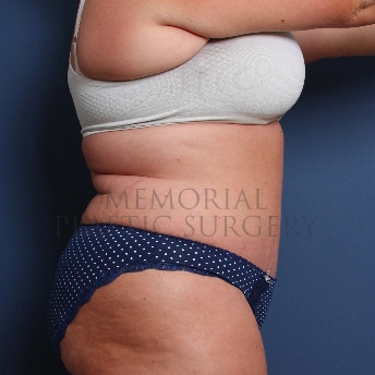 A side view after photo of patient 227 that underwent Abdominoplasty Tummy Tuck procedures at Memorial Plastic Surgery