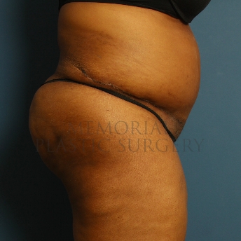 A side view after photo of patient 228 that underwent Abdominoplasty Tummy Tuck procedures at Memorial Plastic Surgery