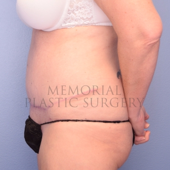 A side view after photo of patient 1253 that underwent Abdominoplasty Tummy Tuck procedures at Memorial Plastic Surgery