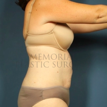 A side view before photo of patient 192 that underwent Abdominoplasty Tummy Tuck procedures at Memorial Plastic Surgery