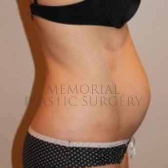 A side view before photo of patient 196 that underwent Abdominoplasty Tummy Tuck procedures at Memorial Plastic Surgery