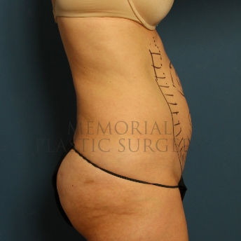 A side view before photo of patient 225 that underwent Abdominoplasty Tummy Tuck procedures at Memorial Plastic Surgery