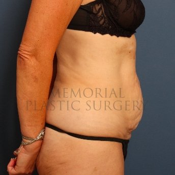 A side view before photo of patient 229 that underwent Abdominoplasty Tummy Tuck procedures at Memorial Plastic Surgery