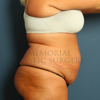 A side view before photo of patient 227 that underwent Abdominoplasty Tummy Tuck procedures at Memorial Plastic Surgery