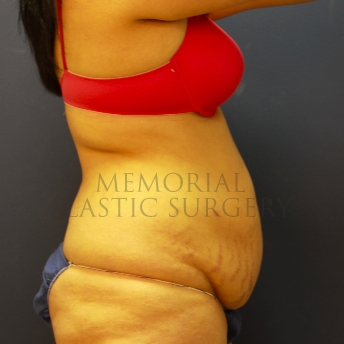 A side view before photo of patient 220 that underwent Abdominoplasty Tummy Tuck procedures at Memorial Plastic Surgery