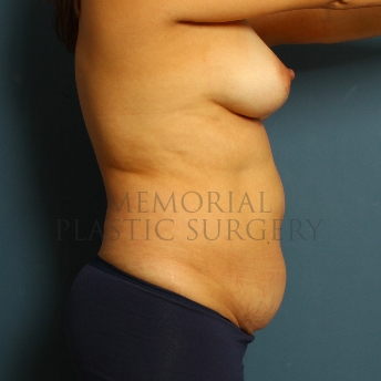 A side view before photo of patient 221 that underwent Abdominoplasty Tummy Tuck procedures at Memorial Plastic Surgery