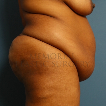 A side view before photo of patient 228 that underwent Abdominoplasty Tummy Tuck procedures at Memorial Plastic Surgery