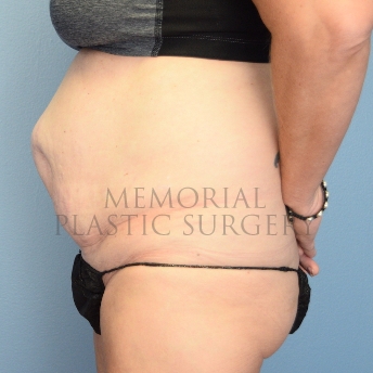 A side view before photo of patient 1253 that underwent Abdominoplasty Tummy Tuck procedures at Memorial Plastic Surgery