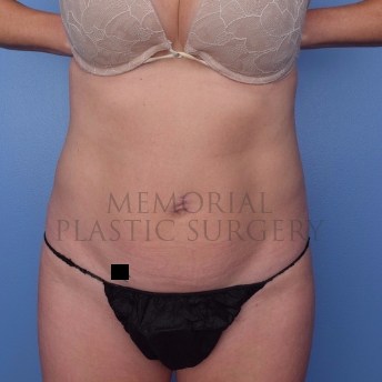 A front view after photo of patient 694 that underwent Abdominoplasty Tummy Tuck:Liposuction procedures at Memorial Plastic Surgery