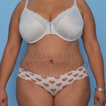 A front view after photo of patient 260 that underwent Abdominoplasty Tummy Tuck:Liposuction procedures at Memorial Plastic Surgery
