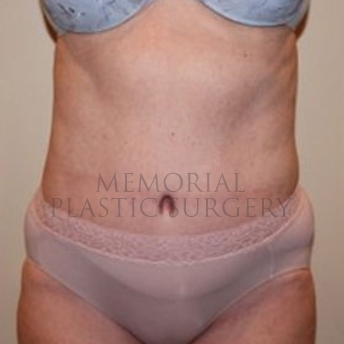 A front view after photo of patient 186 that underwent Abdominoplasty Tummy Tuck:Liposuction procedures at Memorial Plastic Surgery